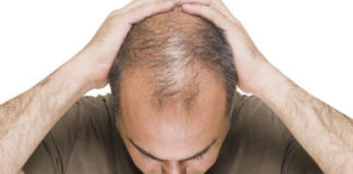 baldness