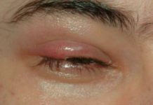 Eye Infection