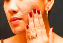 Blackheads