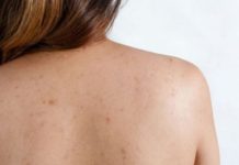 How To Remove Back Acne