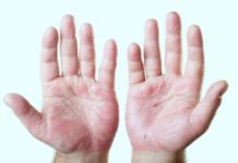peeling fingertips